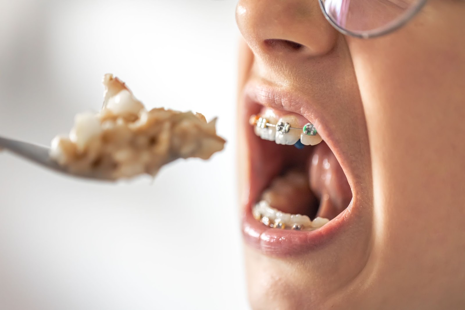 Your Guide to Healthy Eating With Braces in Henderson